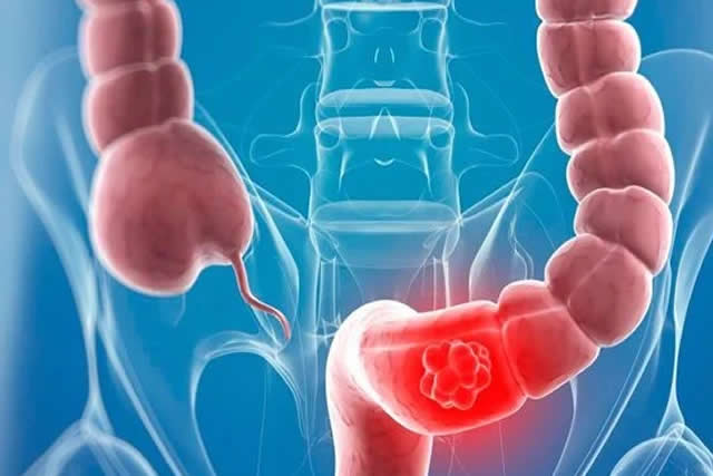 bipsia colon recto y ano